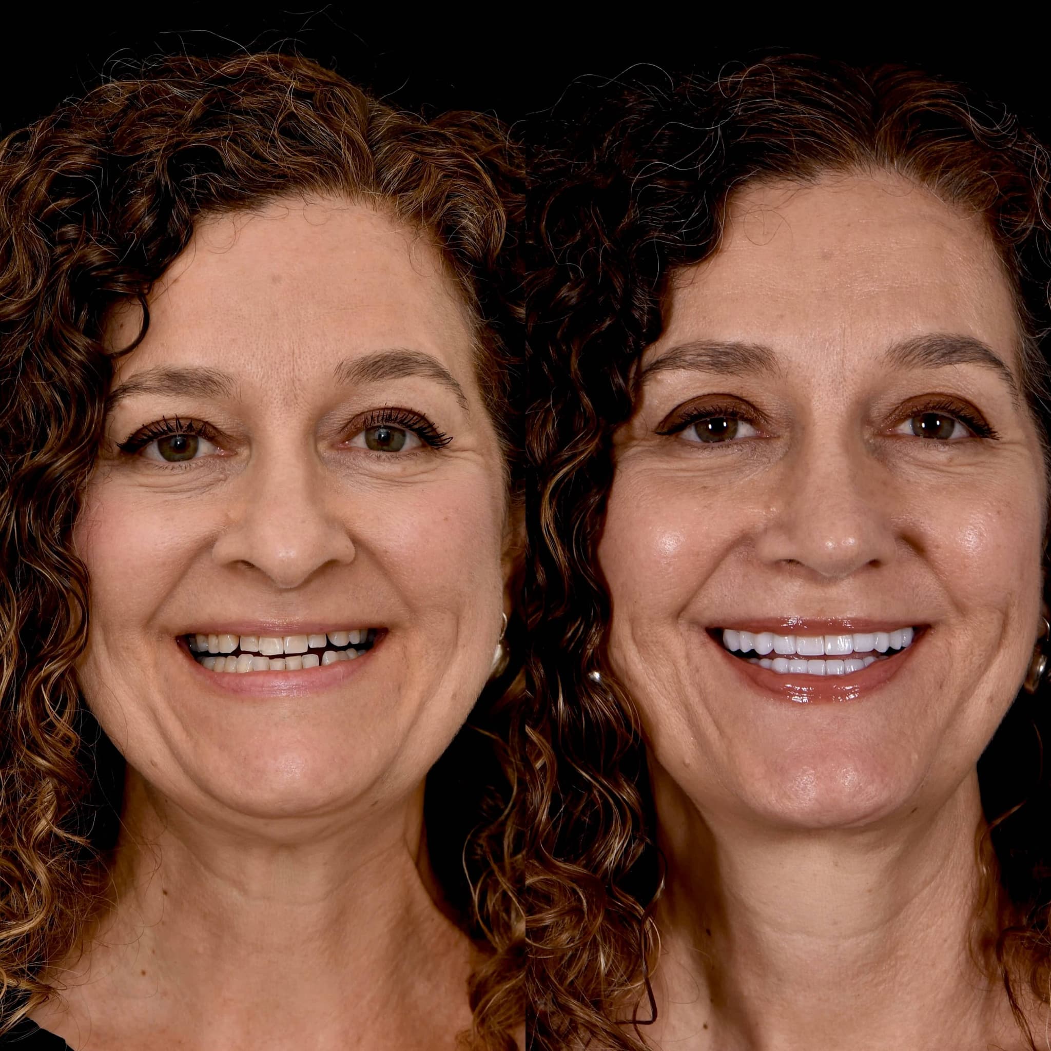 Cosmetic dentistry before and after