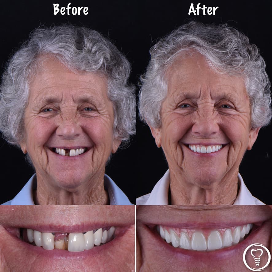 Dental implants before and after