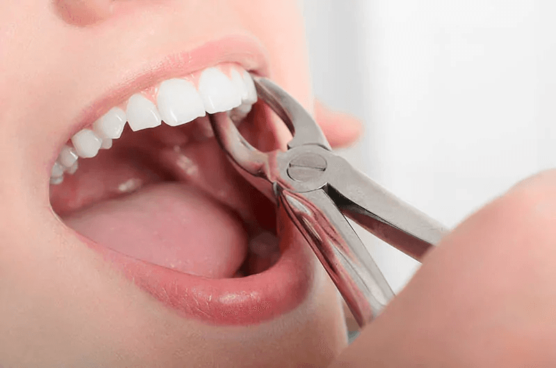 Dental forceps during a tooth extraction