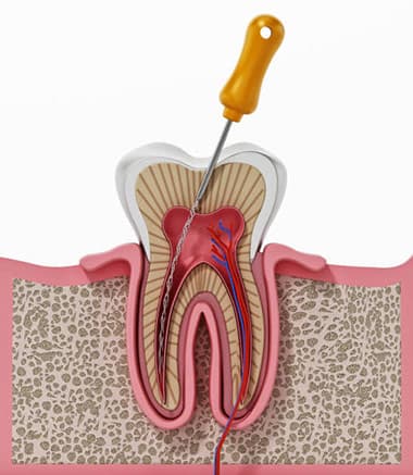 Cross-section illustration of a molar during root canal treatment