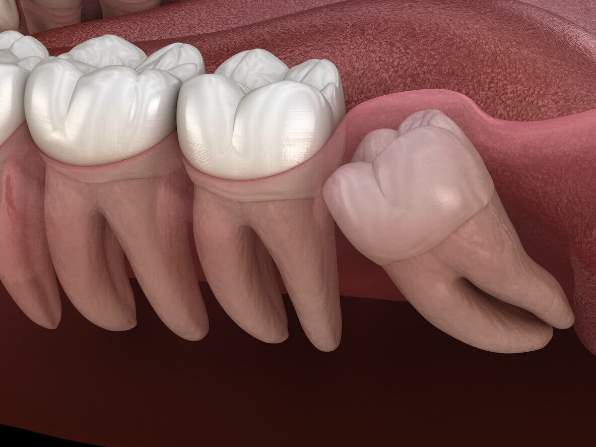 Illustration of an impacted wisdom tooth pressing against adjacent molars