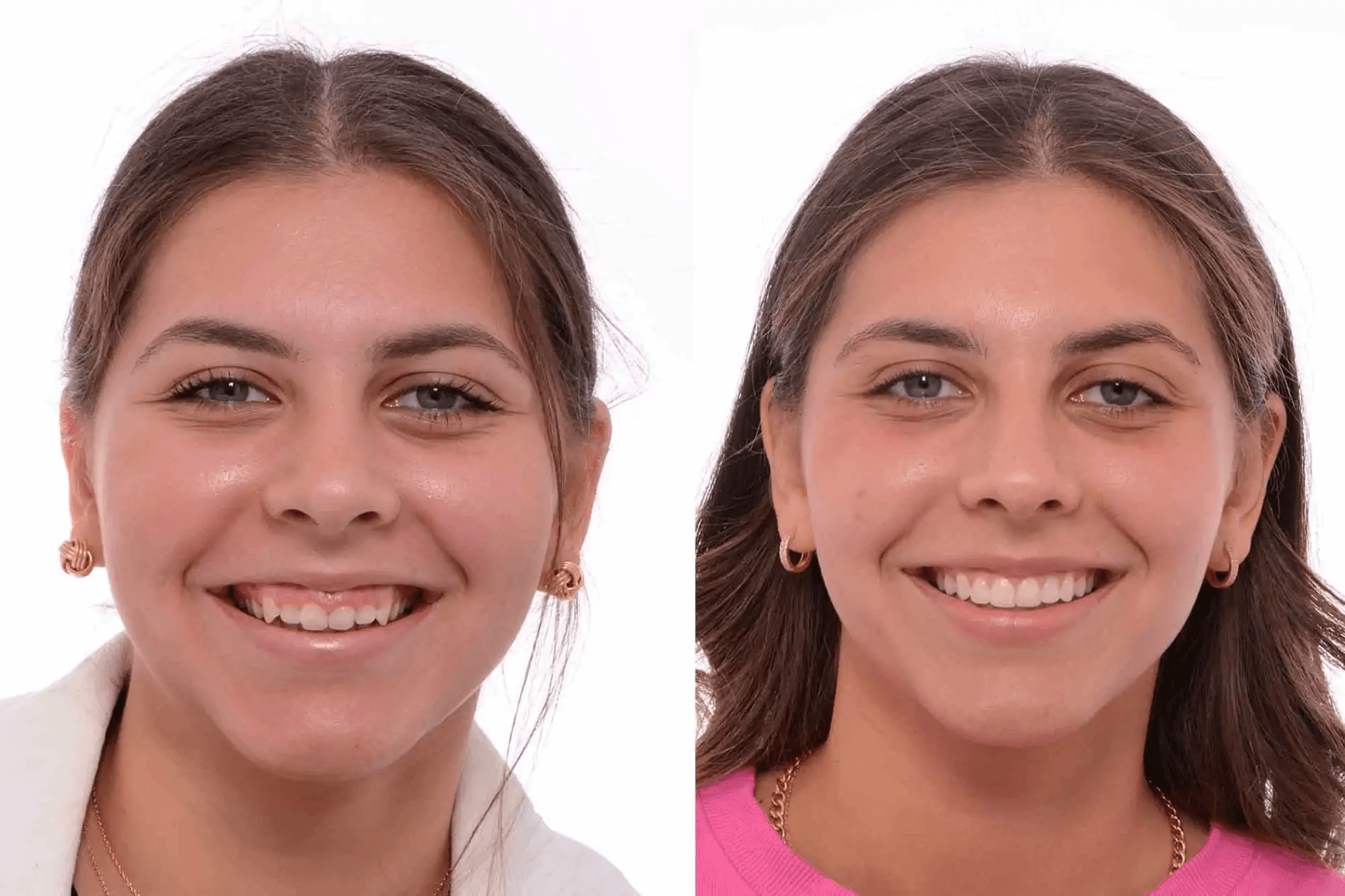 Gummy smile before and after